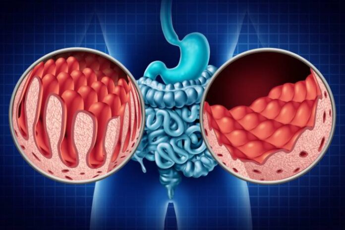 Celiac Disease