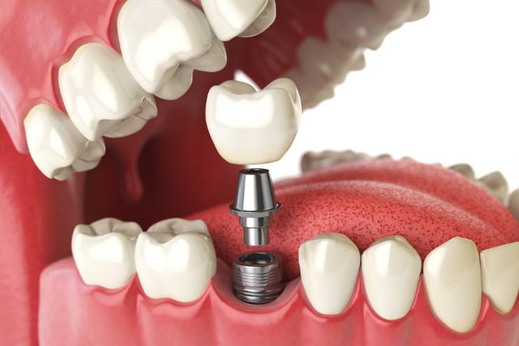 Dental implants surgery