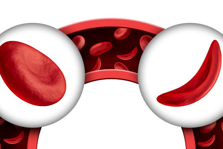 Sickle cell anemia