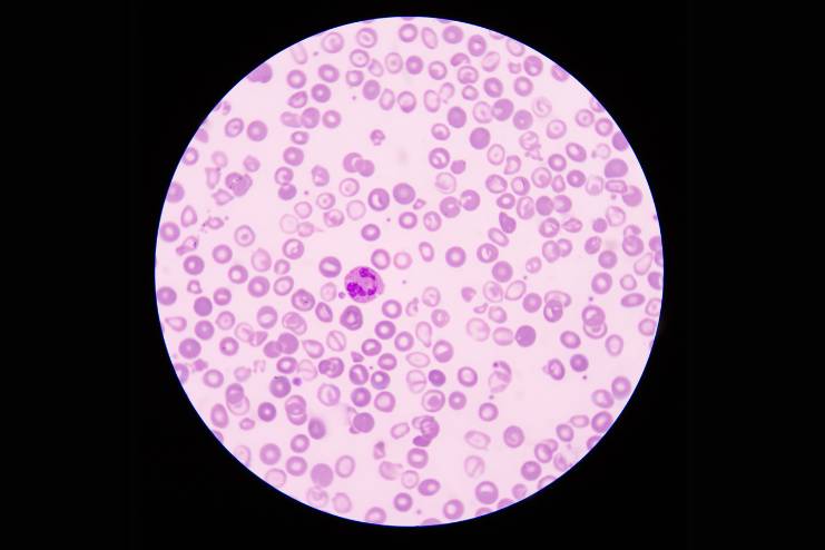 Thalassemia