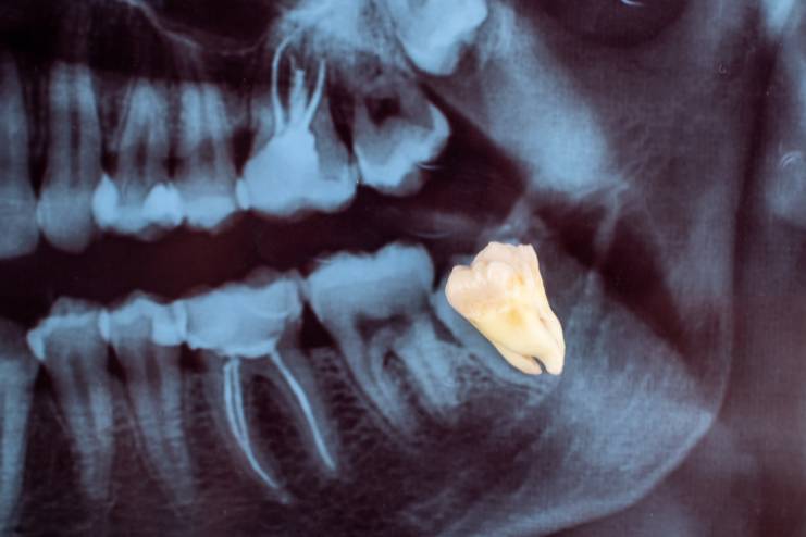 Wisdom tooth extraction