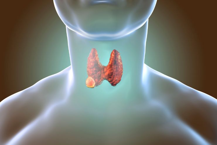 Thyroid Disorders