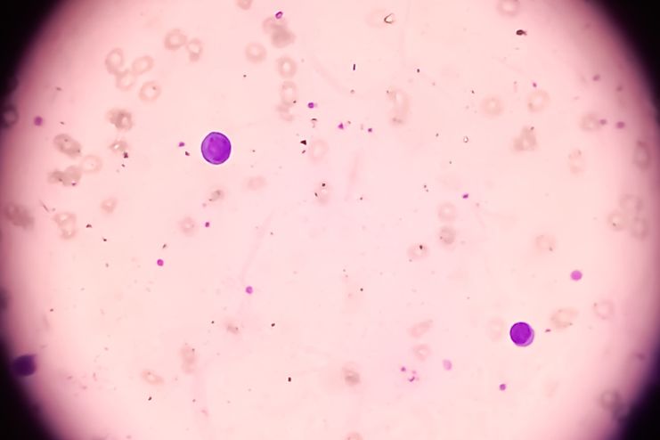 severe aplastic anemia diagnose