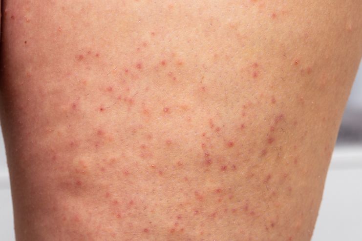 Actinic keratosis