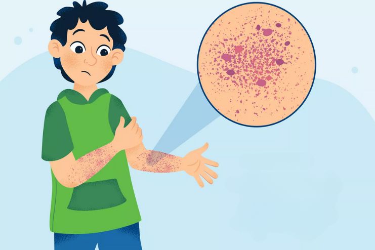 Causes for Thrombocytopenia