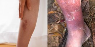 సెల్యులైటిస్: రకాలు, లక్షణాలు, కారణాలు, చికిత్స - Cellulitis: Types, Symptoms, Causes and Treatment Cellulitis_ Types, Symptoms, Causes and Treatment