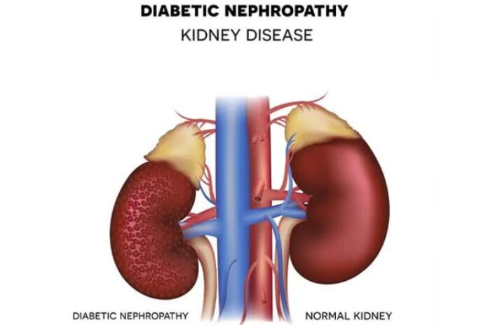 Diabetic Nephropathy