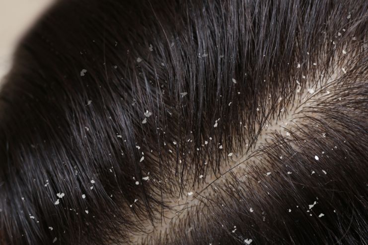 Dry Skin Dandruff