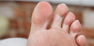 గ్యాంగ్రీన్: రకాలు, కారకాలు, నిర్థారణ, చికిత్స, నివారణ - Gangrene : Types, Symptoms, Diagnosis, and Treatment Gangrene _ Types, Symptoms, Diagnosis, and Treatment