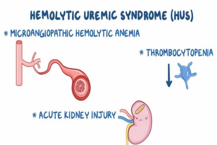 Hemolytic uremic syndrome