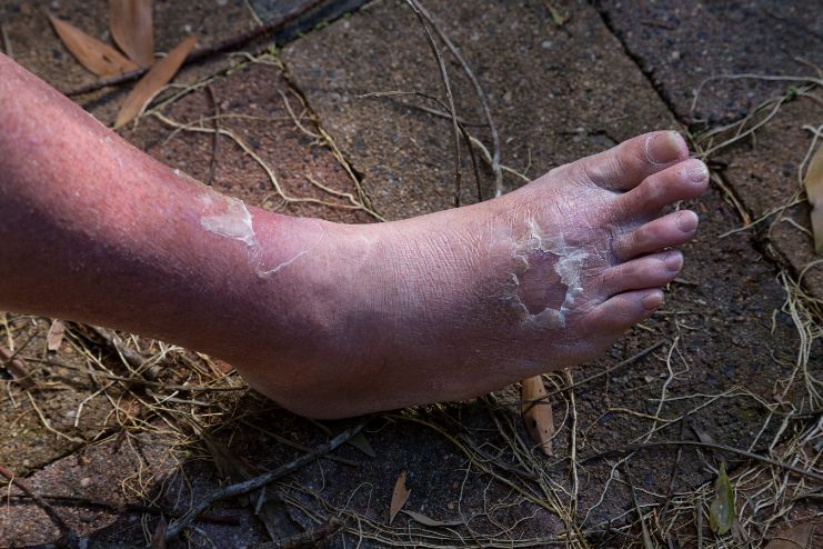 How common is Cellulitis