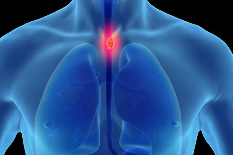 Hypopharyngeal Cancer Staging