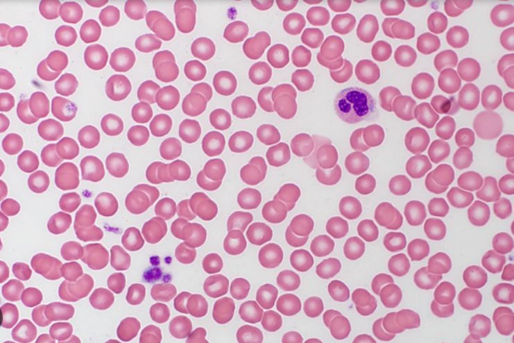 MYH9-related thrombocytopenia