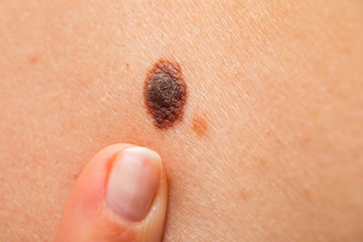 Melanoma