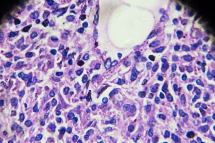 Non-Hodgkin’s lymphoma