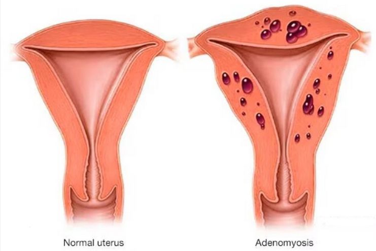 Causes of Adenomyosis