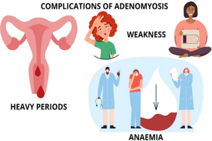 Potential complications of adenomyosis