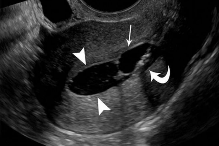 Sonohysterography