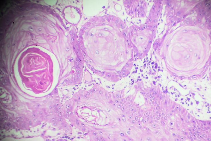 Squamous cell carcinoma