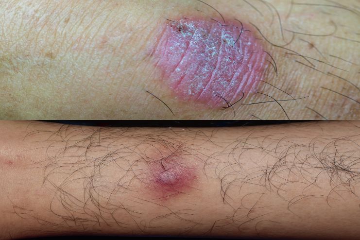 Symptoms of Cellulitis