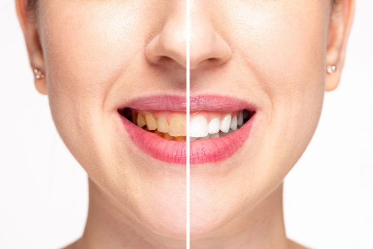 Teeth whitening options