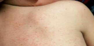 పిల్లలలో థ్రోంబోసైటోపెనియా: కారణాలు, లక్షణాలు మరియు చికిత్స - Thrombocytopenia in Children: Causes, Symptoms, and Treatment Thrombocytopenia in Children_ Causes, Symptoms, and Treatment