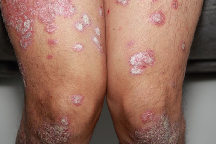 What is Cellulitis