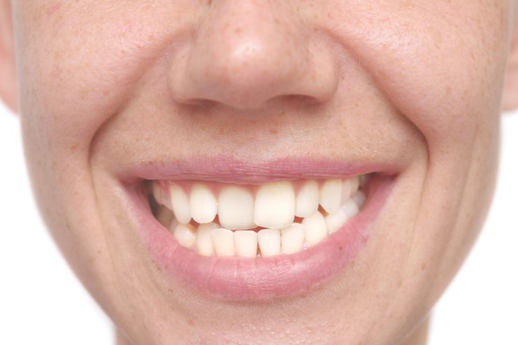 What is Teeth Whitening