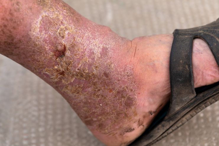 Who’s at risk for developing gangrene