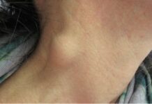 మెడ గడ్డలు ఏర్పడటానికి కారణమేమిటి? నిర్థారణ, చికిత్స neck lump