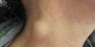 మెడ గడ్డలు ఏర్పడటానికి కారణమేమిటి? నిర్థారణ, చికిత్స - Neck Lump: Causes, Symptoms, Diagnosis and Treatment neck lump