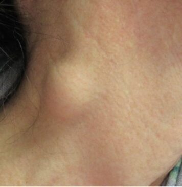 మెడ గడ్డలు ఏర్పడటానికి కారణమేమిటి? నిర్థారణ, చికిత్స neck lump