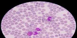 బ్లడ్ పాయిజనింగ్ ప్రాణాంతకమా.? లక్షణాలు, చికిత్స.! - Blood Poisoning: Key Symptoms and How to Treat It Blood Poisoning_ Key Symptoms and How to Treat It