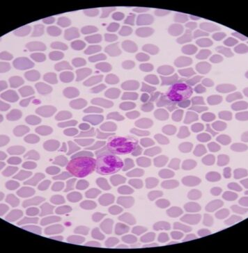 బ్లడ్ పాయిజనింగ్ ప్రాణాంతకమా.? లక్షణాలు, చికిత్స.! Blood Poisoning_ Key Symptoms and How to Treat It