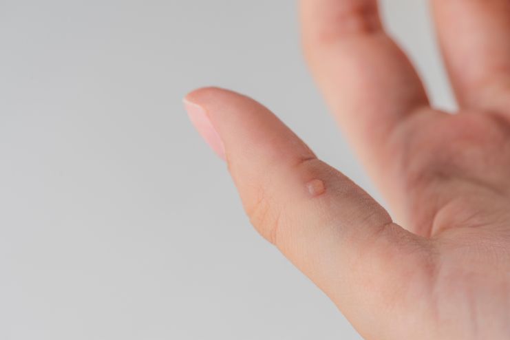 Butchers’ warts on your fingers and hands