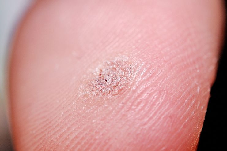 Flat warts on your fingers and hands