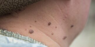 పులిపిర్లు: సహజంగా, వైద్య పద్ధతుల ద్వారా తొలగించే మార్గాలు - Warts Removal: Natural and Medical Methods for Every Type Warts Removal_ Natural and Medical Methods