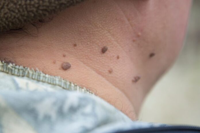 Warts Removal_ Natural and Medical Methods