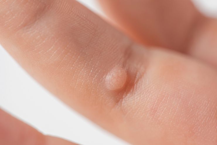 Warts on your fingers and hands