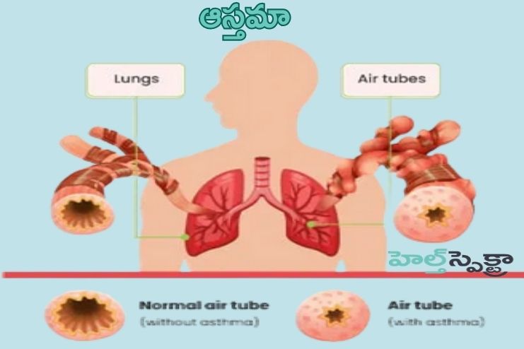 Asthma