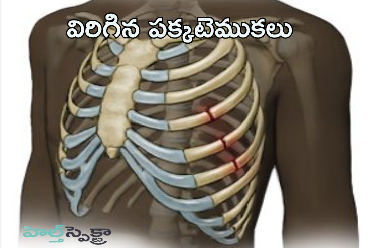 Broken rib
