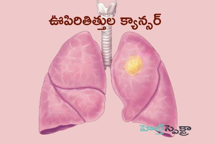 Lung cancer