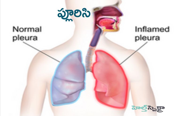 Pleurisy