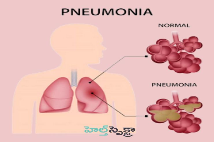 Pneumonia