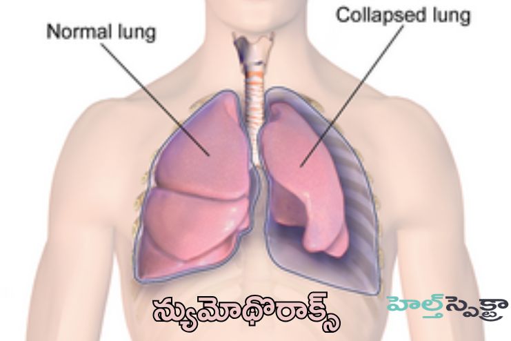 Pneumothorax