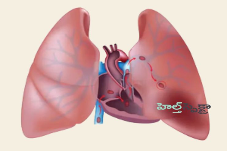 Prevention of Pulmonary Embolism