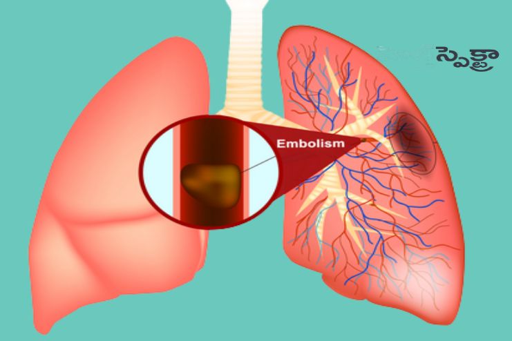 Pulmonary embolism 2