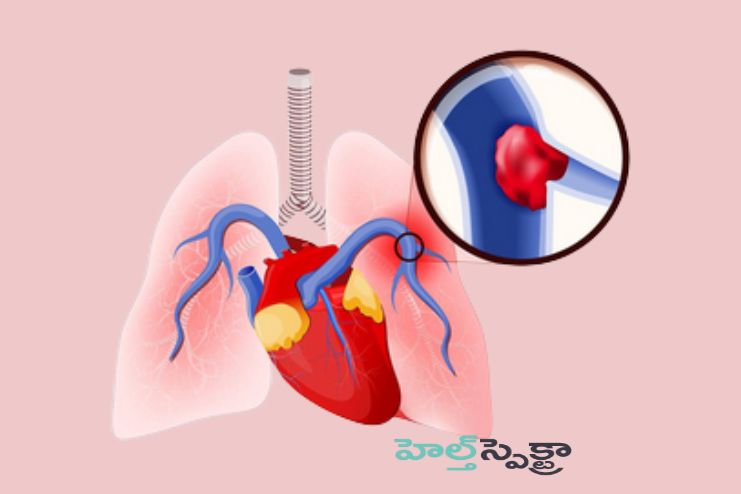 Pulmonary embolism