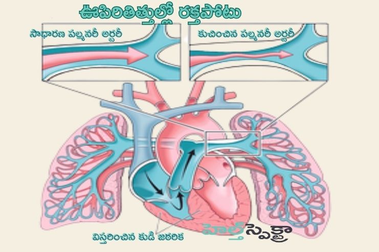 Pulmonary hypertension