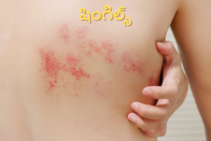 Shingles